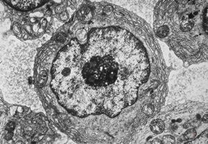 F,72y. | blood - lymphoplasmocellular leukemia